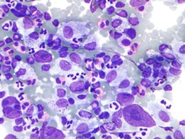 Immunotherapy could offer hope for some men with aggressive prostate cancers