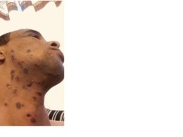 “MY FACE WAS ON FIRE” – London man warns others about laser hair removal