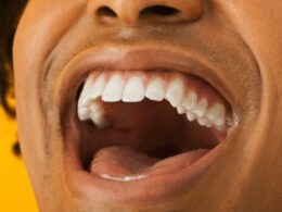 Reasons To Consider The Use Of Veneers
