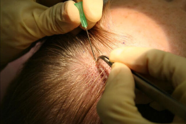 Follicular Unit Extraction hair