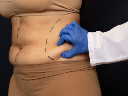 Key Things You Need To Stop Doing If You Are Considering Liposuction