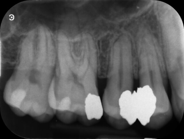 deep filling upper right premolar (2)